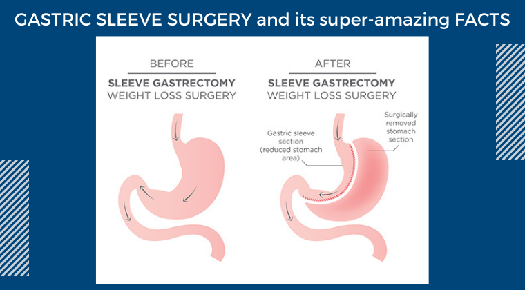 GASTRIC-SLEEVE-SURGERY-and-its-super-amazing-FACTS