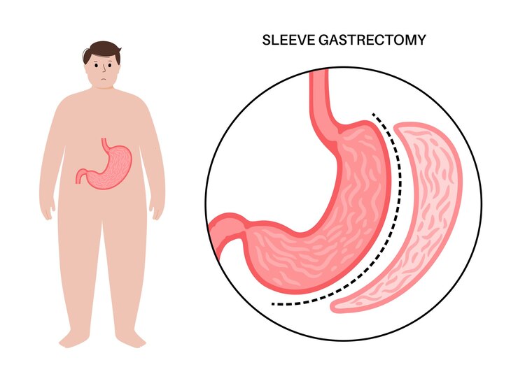 vertical-sleeve-gastrectomy