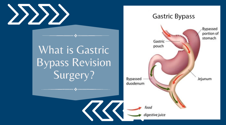 What is gastric bypass revision surgery