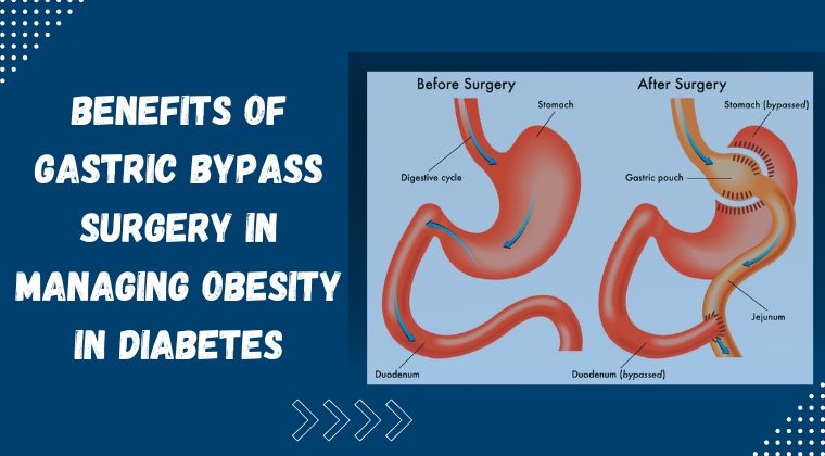 Benefits of Gastric bypass surgery